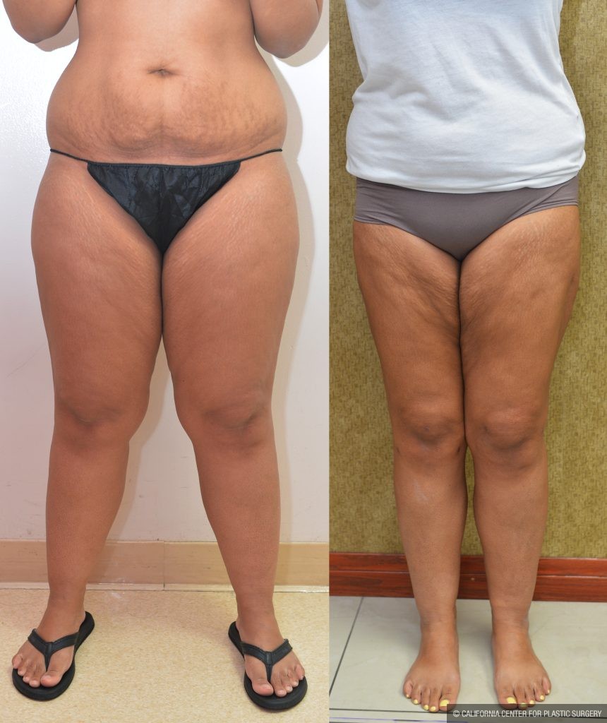 Thigh Lift Before & After Patient #13872