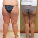 Thigh Lift Before & After Patient #13872