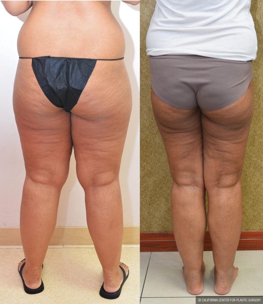 Thigh Lift Before & After Patient #13872