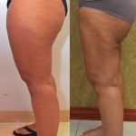 Thigh Lift Before & After Patient #13872