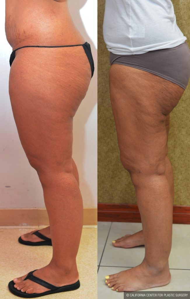 Thigh Lift Before & After Patient #13872