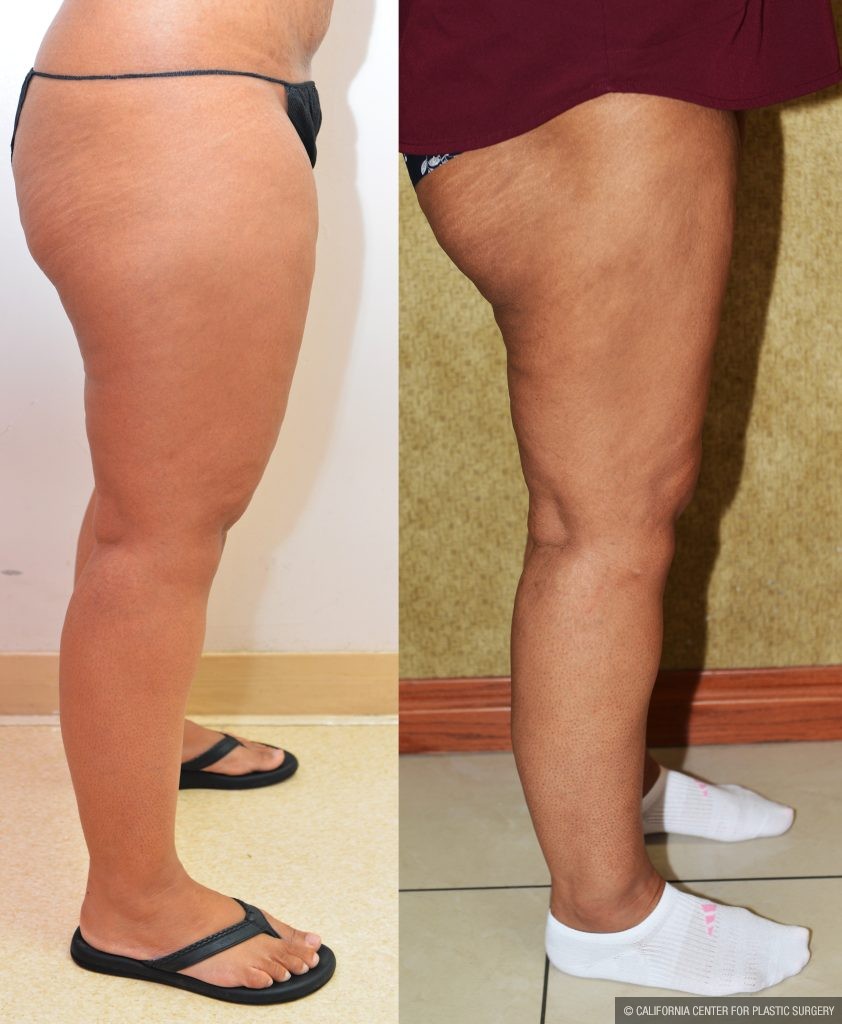 Thigh Lift Before & After Patient #13872