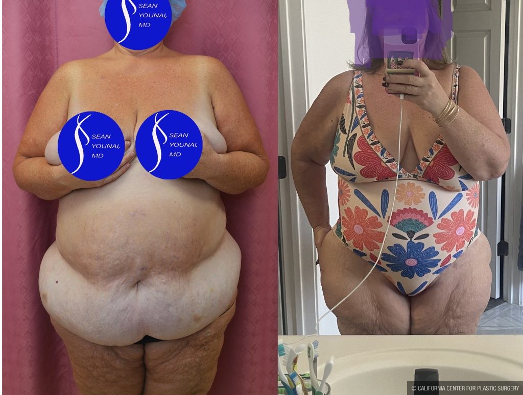 Tummy Tuck (Abdominoplasty) Super Plus Size Before & After Patient #13882