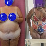 Tummy Tuck (Abdominoplasty) Super Plus Size Before & After Patient #13882