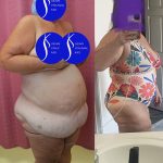 Tummy Tuck (Abdominoplasty) Super Plus Size Before & After Patient #13882