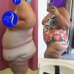 Tummy Tuck (Abdominoplasty) Super Plus Size Before & After Patient #13882