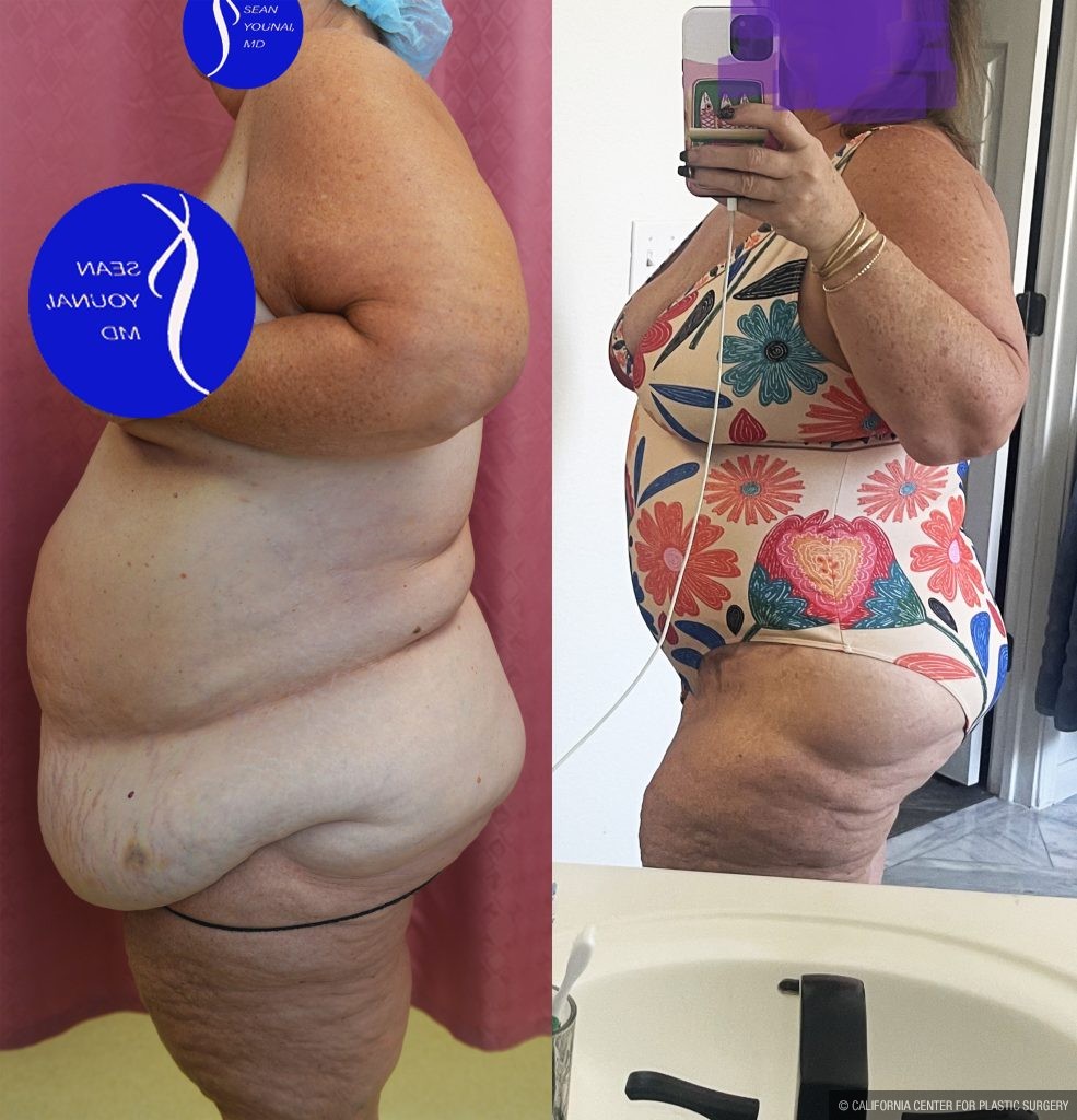 Tummy Tuck (Abdominoplasty) Super Plus Size Before & After Patient #13882
