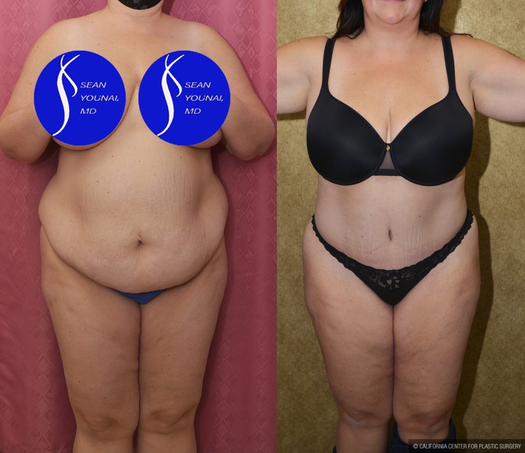 Tummy Tuck (Abdominoplasty) Plus Size Before & After Patient #13877