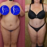 Tummy Tuck (Abdominoplasty) Plus Size Before & After Patient #13877