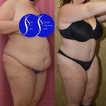 Tummy Tuck (Abdominoplasty) Plus Size Before & After Patient #13877