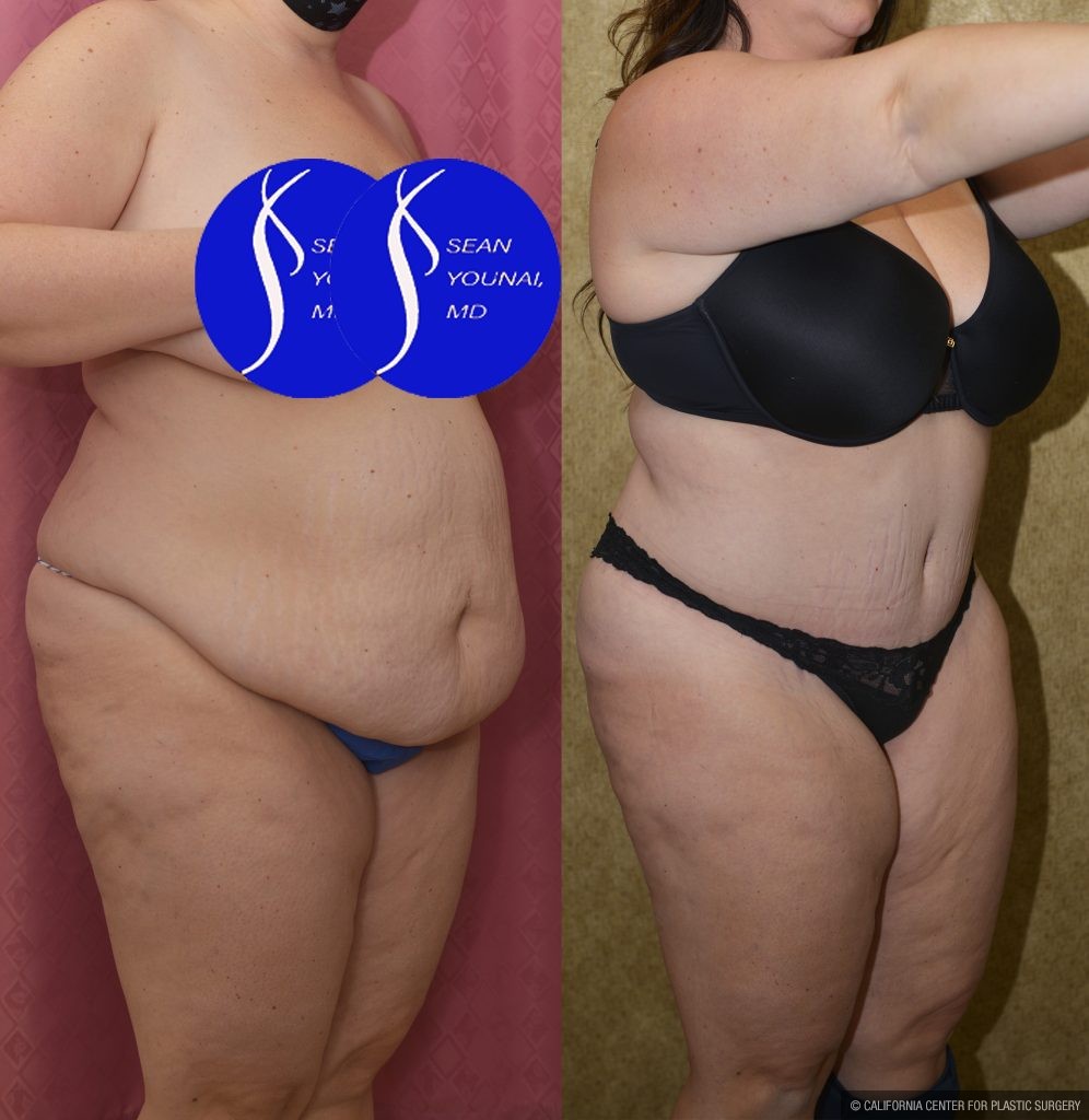 Tummy Tuck (Abdominoplasty) Plus Size Before & After Patient #13877