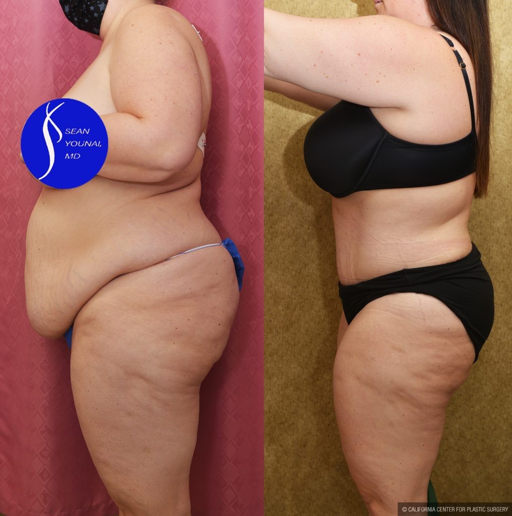 Tummy Tuck (Abdominoplasty) Plus Size Before & After Patient #13877