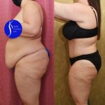 Tummy Tuck (Abdominoplasty) Plus Size Before & After Patient #13877