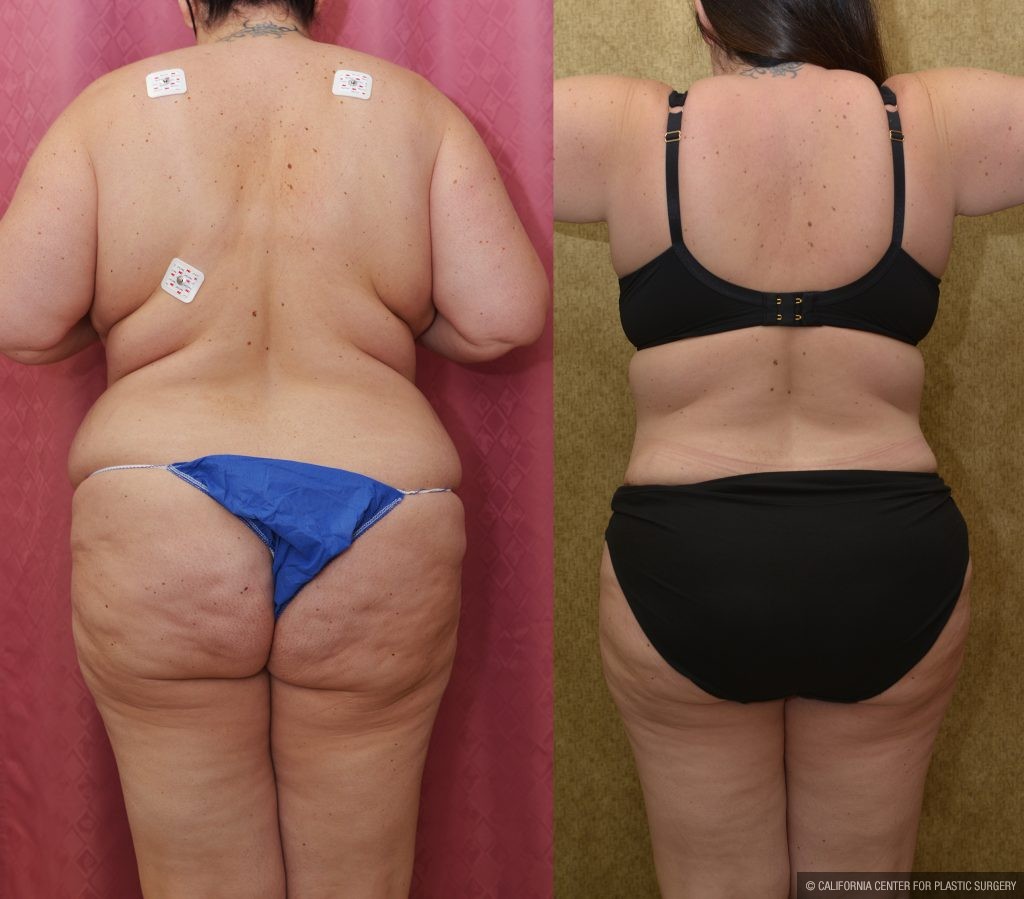 Tummy Tuck (Abdominoplasty) Plus Size Before & After Patient #13877