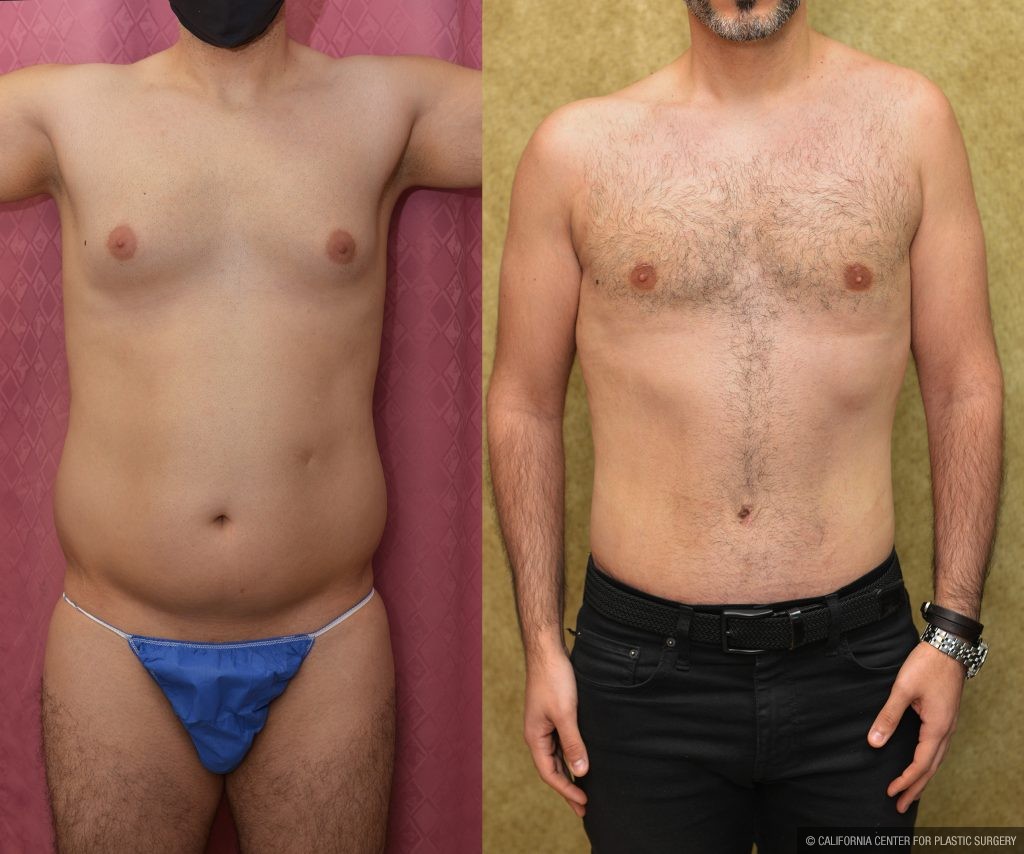 Male Tummy Tuck (abdominoplasty) Before & After Patient #13997