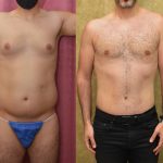 Male Tummy Tuck (abdominoplasty) Before & After Patient #13997