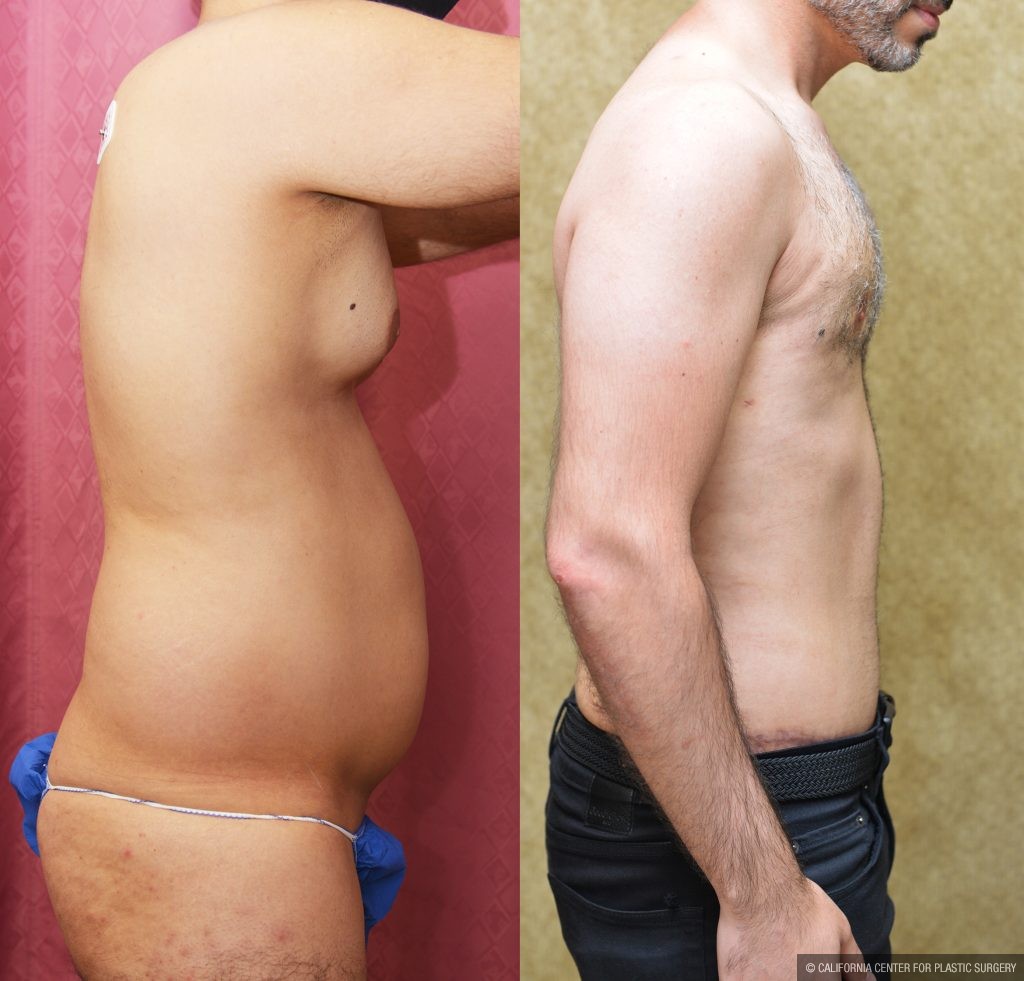 Male Tummy Tuck (abdominoplasty) Before & After Patient #13997