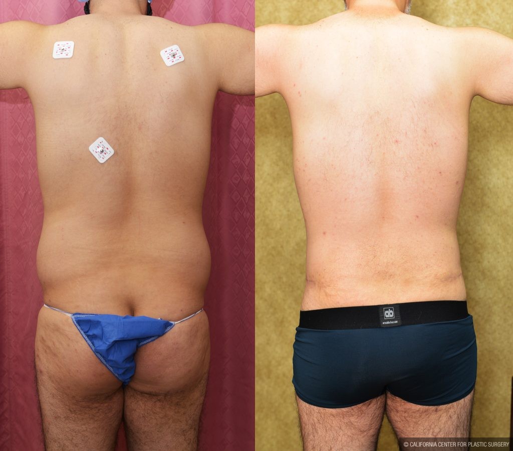 Male Tummy Tuck (abdominoplasty) Before & After Patient #13997