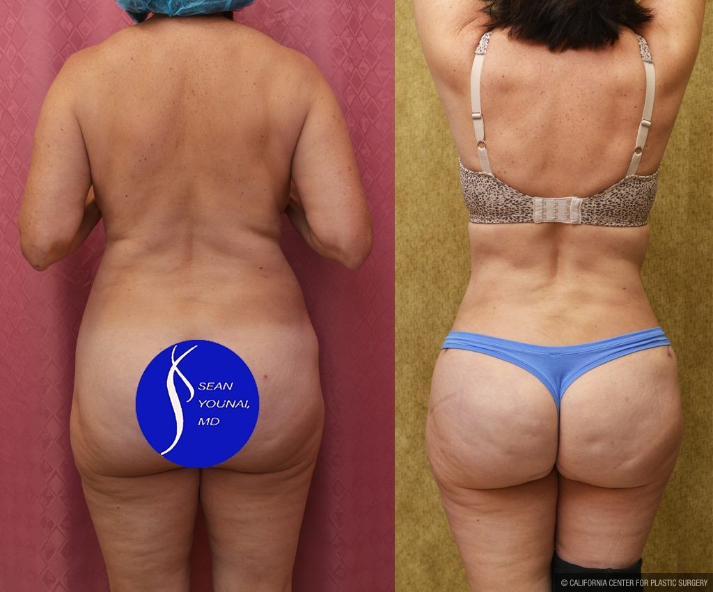 Tummy Tuck (Abdominoplasty) Small Size Before & After Patient #13998