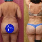 Tummy Tuck (Abdominoplasty) Small Size Before & After Patient #13998