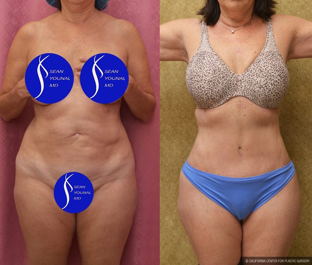 Tummy Tuck (Abdominoplasty) Small Size Before & After Patient #13998