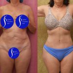 Tummy Tuck (Abdominoplasty) Small Size Before & After Patient #13998
