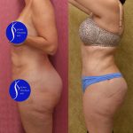 Tummy Tuck (Abdominoplasty) Small Size Before & After Patient #13998