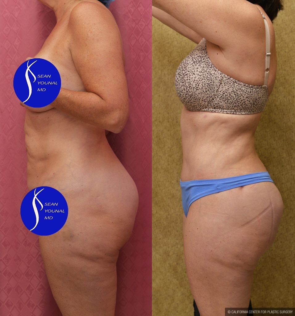 Tummy Tuck (Abdominoplasty) Small Size Before & After Patient #13998