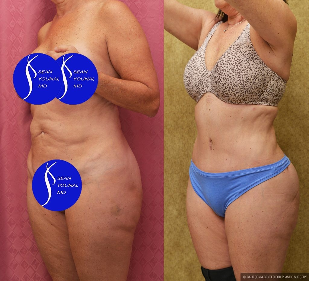 Tummy Tuck (Abdominoplasty) Small Size Before & After Patient #13998