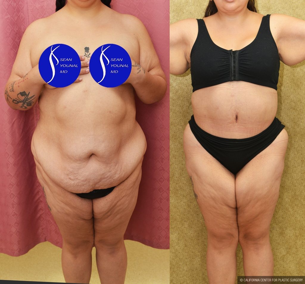 Tummy Tuck (Abdominoplasty) Super Plus Size Before & After Patient #13999