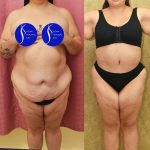 Tummy Tuck (Abdominoplasty) Super Plus Size Before & After Patient #13999