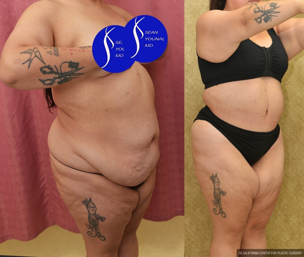 Tummy Tuck (Abdominoplasty) Super Plus Size Before & After Patient #13999