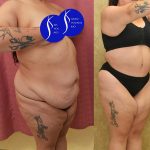 Tummy Tuck (Abdominoplasty) Super Plus Size Before & After Patient #13999