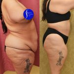 Tummy Tuck (Abdominoplasty) Super Plus Size Before & After Patient #13999