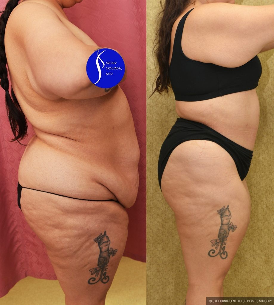 Tummy Tuck (Abdominoplasty) Super Plus Size Before & After Patient #13999