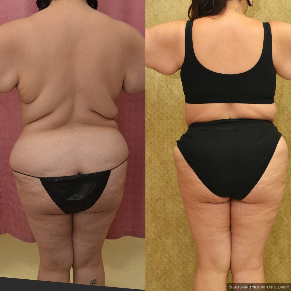Tummy Tuck (Abdominoplasty) Super Plus Size Before & After Patient #13999