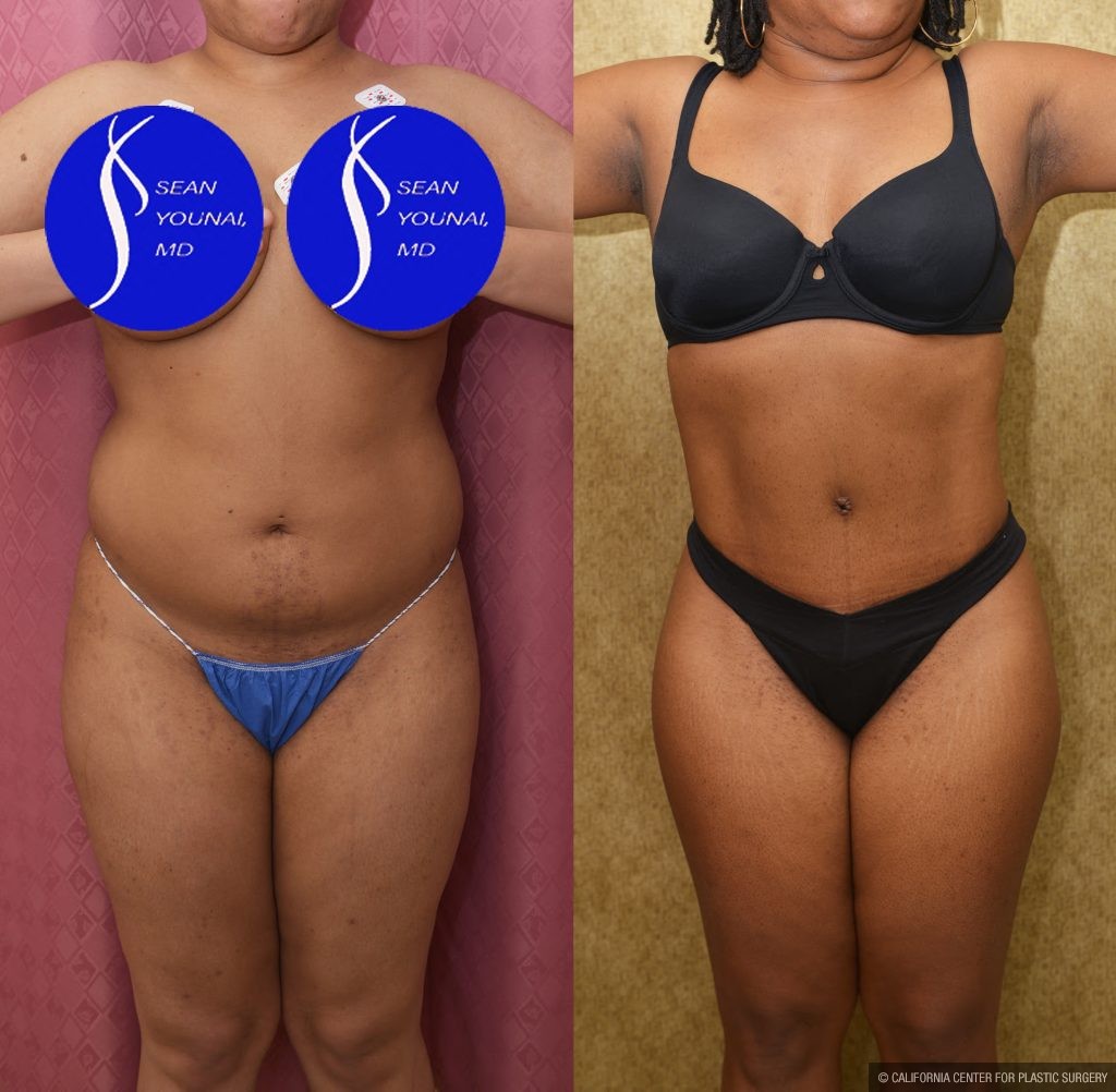 Liposuction Abdomen Medium Before & After Patient #13996