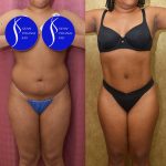 Liposuction Abdomen Medium Before & After Patient #13996