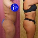 Liposuction Abdomen Medium Before & After Patient #13996