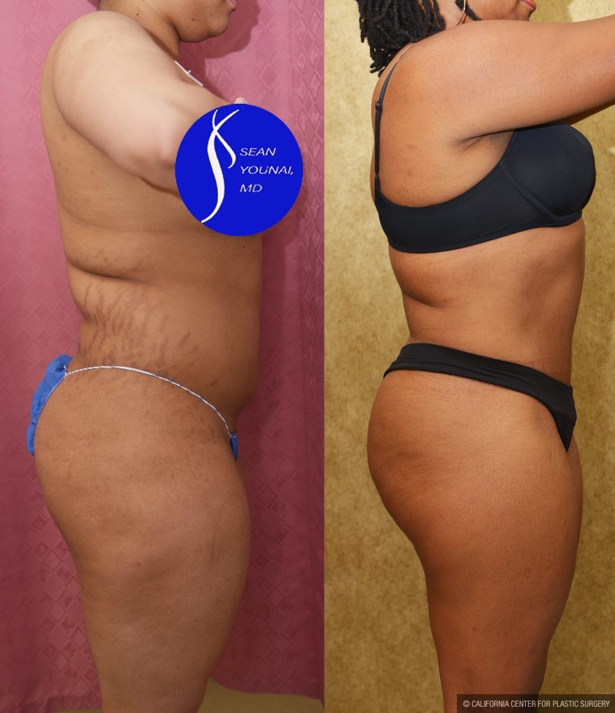 Liposuction Abdomen Medium Before & After Patient #13996