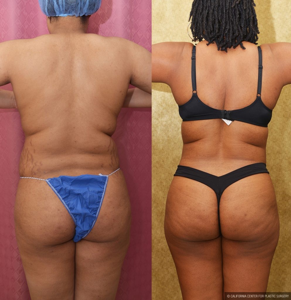 Liposuction Abdomen Medium Before & After Patient #13996