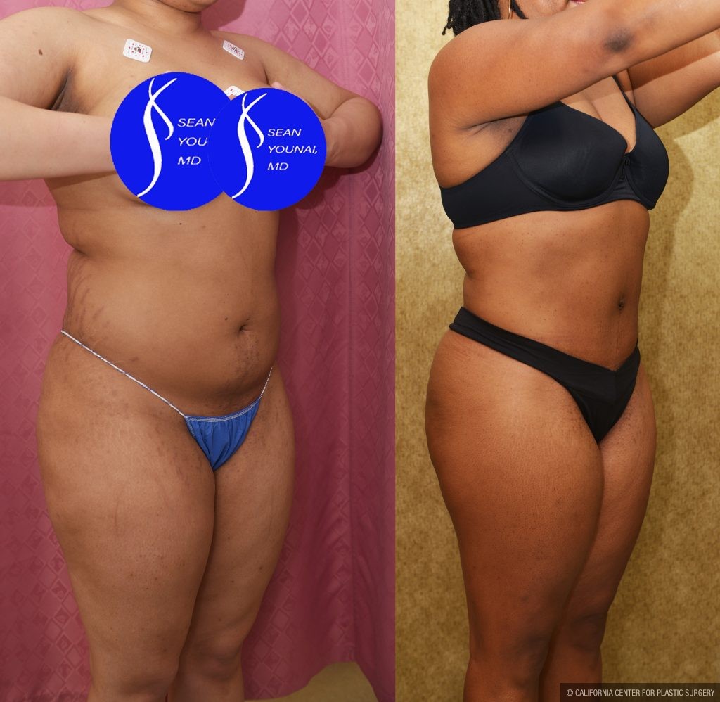 Liposuction Abdomen Medium Before & After Patient #13996