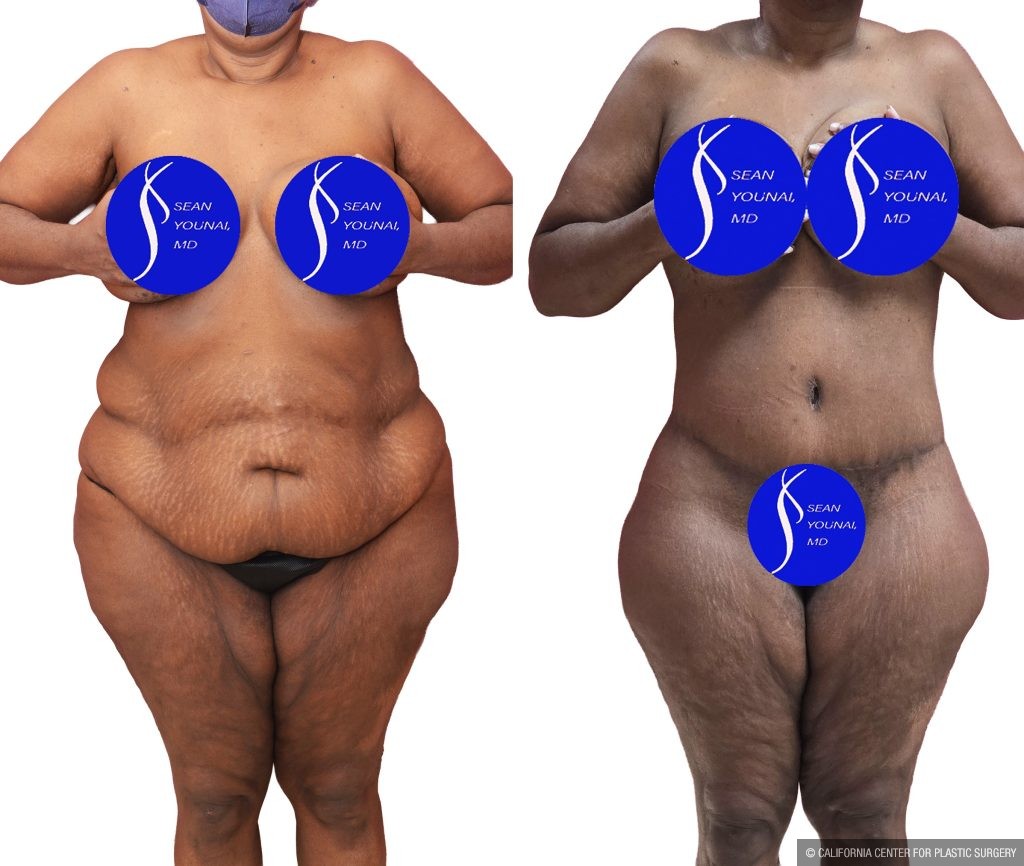 Body Lift Before & After Patient #14016