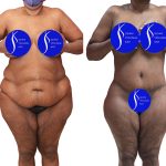 Body Lift Before & After Patient #14016