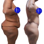 Body Lift Before & After Patient #14016