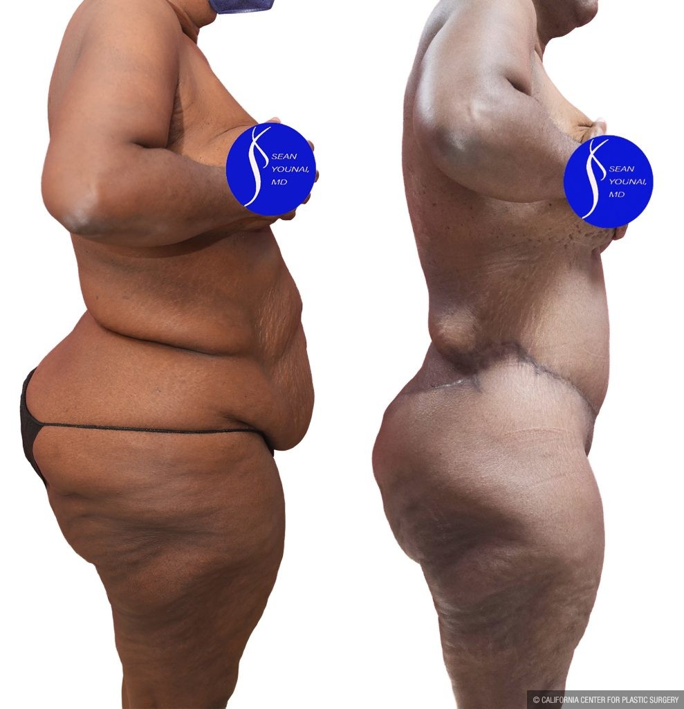 Body Lift Before & After Patient #14016