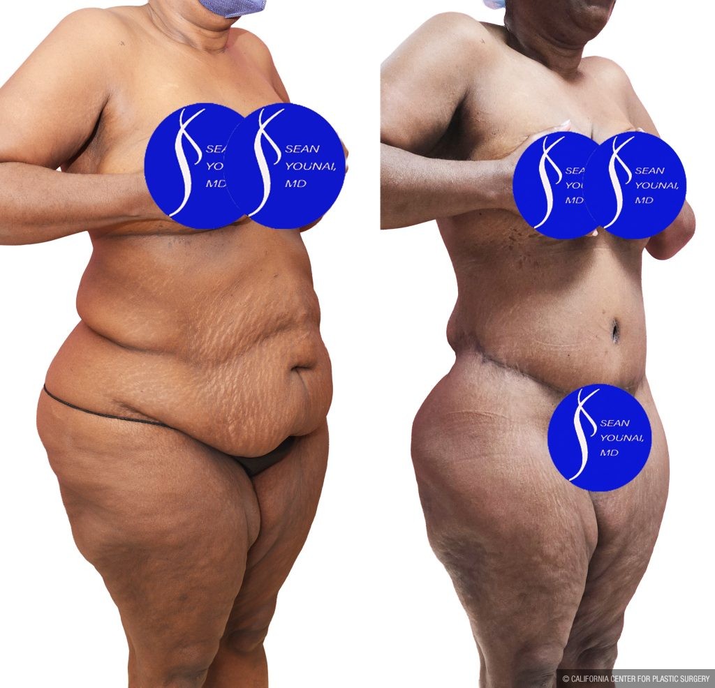 Body Lift Before & After Patient #14016