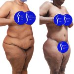 Body Lift Before & After Patient #14016