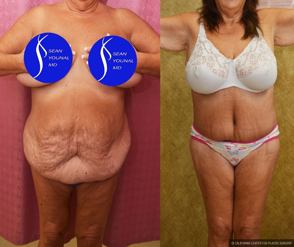 Body Lift Before & After Patient #14017