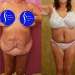Body Lift Before & After Patient #14017